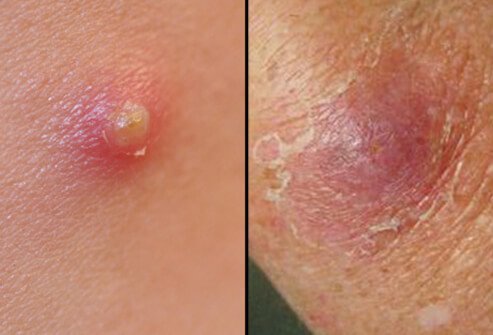 Symptoms of boils start out as a hard, red, painful lump which eventually becomes softer, larger, and soon formsming a pocket of pus.