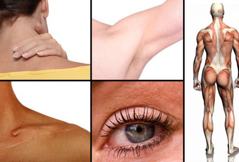 The most common places for boils to appear are on your neck, armpits, shoulders, and buttocks.