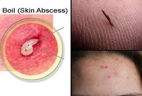 Boils are usually caused by bacteria called Staphylococcus (staph). Some boils can be caused by an ingrown hair, splinter or other foreign material, or acne.