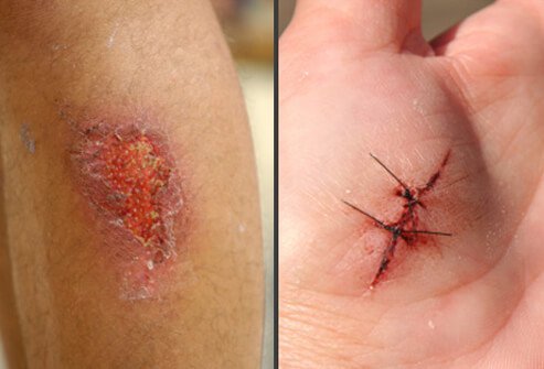 A boil may develop from a cut or scrape if it becomes infected with bacteria.