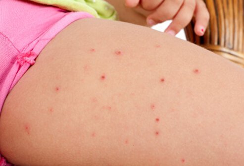 Folliculitis, an inflammation or infection of the hair follicles, is seen here on a child's leg.