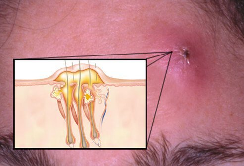 Carbuncles are considered more serious skin conditions.