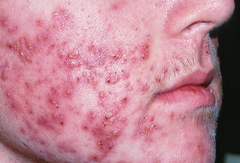Cystic acne affects deeper skin tissue than common acne.
