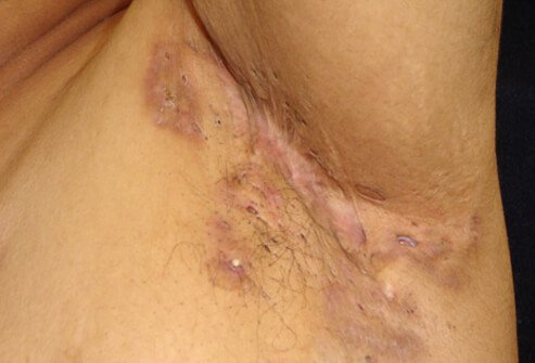 Hidradenitis suppurativa consists of multiple abscesses that form under the armpits (shown below) and in the groin area.