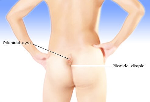 A pilonidal cyst is a unique kind of abscess that occurs in or above the crease of the buttocks.