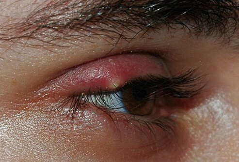 A sty (stye) is a tender, painful red bump located at the base of an eyelash or under or inside the eyelid.