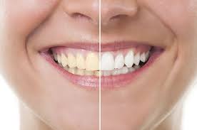 چگونه از شر دندان های زرد خلاص شویم؟