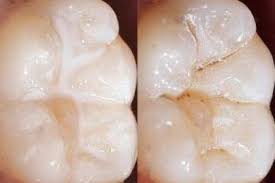 شیاربندی دندان یا فیشور سیلانت چیست؟